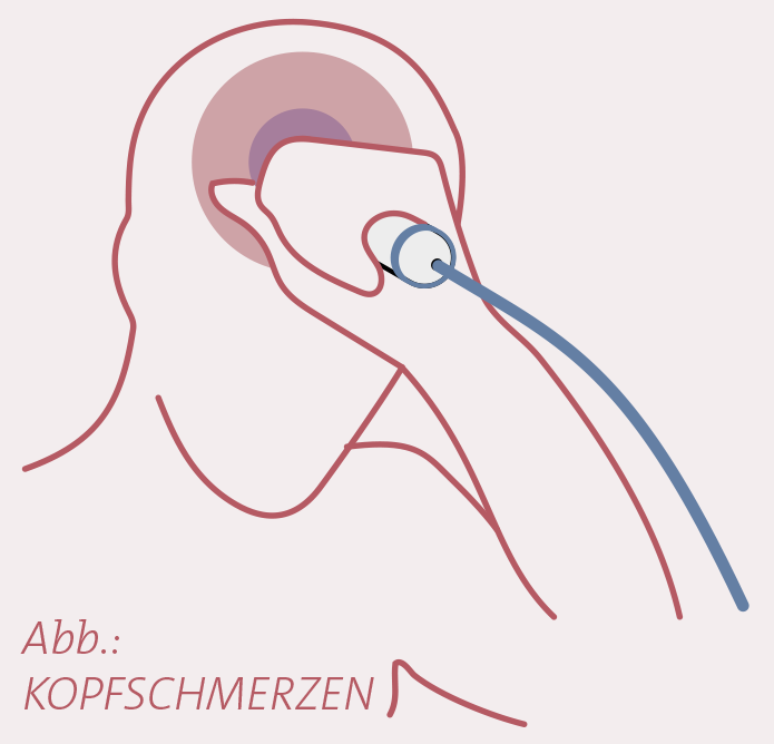 Kopfschmerzen